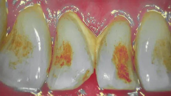 C50 perio mode intraoral camera